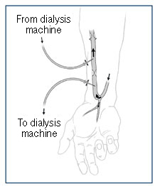 Drawing of the underside of a forearm with an arteriovenous fistula. Arrows show the direction of blood flow. Two needles are inserted into the fistula. Labels explain that one needle carries blood to the dialysis machine and the other needle returns blood from the dialysis machine.