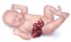 Picture of Gastroschisis