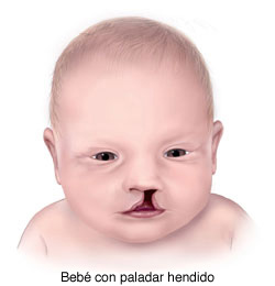 bebé con labio hendido 