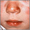 Lupus discoide en el rostro de un niño