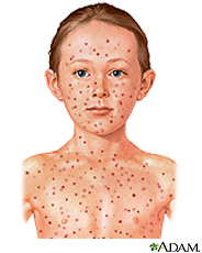 Illustration of child with chicken pox