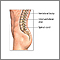 Spinal fusion  - series