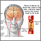 Aterosclerosis de la arteria carótida interna