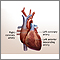 Cirugía de derivación cardíaca - Serie