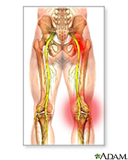 Illustration of sciatic nerve damage