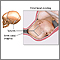 Fetal head molding