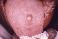 Primary stage syphilis sore (chancre) on the surface of a tongue.