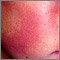 Keratosis pilaris rubra faceii