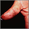 Dermatitis, herpetiformis on the thumb