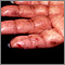 Dermatitis, herpetiformis on the hand