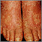 Pitiriasis rubra pilaris en los pies