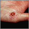 Granuloma piogénico en la mano