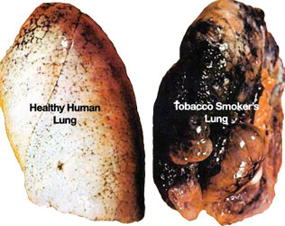 A healthy lung compared to a smoker's lung