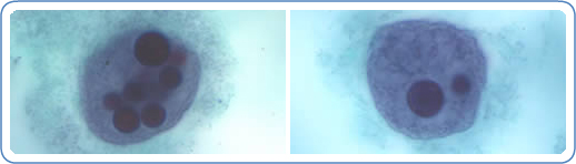 Trophozoites of E. histolytica with ingested erythrocytes (red blood cells) stained with trichrome.