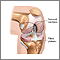 Knee joint replacement - series