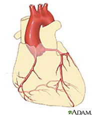 Illustration of the heart featuring the right coronary artery