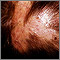 Folliculitis, decalvans on the scalp