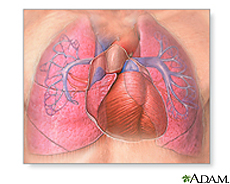 Illustration showing the narrowing of the pulmonary artery and an enlarged right ventricle