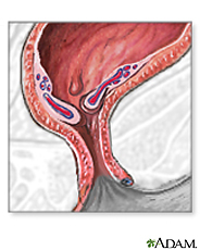 Illustration of inflamed hemorrhoids