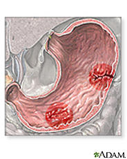 Illustration of stomach ulcers