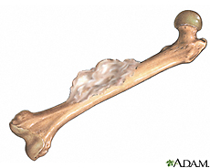 Illustration of osteosarcoma
