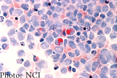 Human cells with acute myelocytic leukemia (AML)