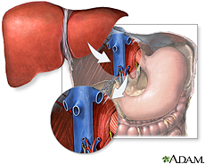 Illustration of liver transplantation