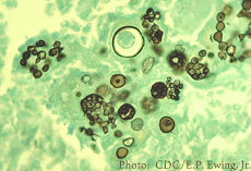 Histopathology of coccidioidomycosis