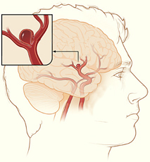 Drawing of a brain aneurysm.