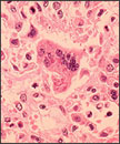 Picture of the measles virus