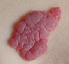 A photograph of a capillary haemangioma