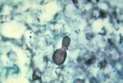 Histopathology showing a yeast cell of Blastomyces dermatitidis