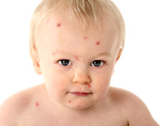 Baby with chickenpox