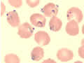 Plasmodium falciparum parasites in a thin blood smeararasite.