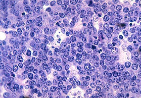 A pathology slide stained purple showing misshapen cells indicating malignant Burkitt lymphoma.