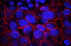 Microscopic view of breast cancer cells with cell nuclei stained blue and dots responding to overproduction of the HER2 protein lit up in bright red 