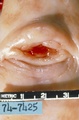 Diethylstilbestrol (DES) Cervix