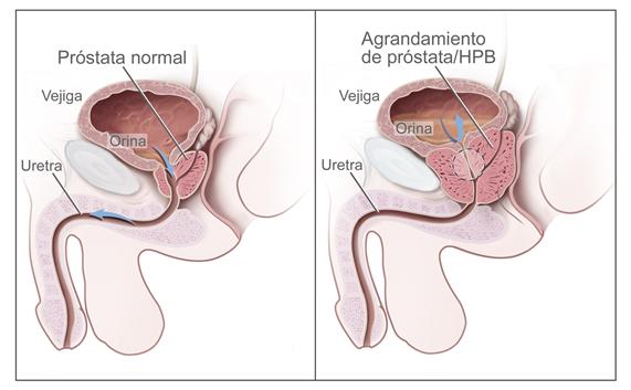 Un dibujo en dos paneles muestra la anatomía reproductora y urinaria normal así como hiperplasia prostática benigna (HPB).  El panel de la izquierda muestra la próstata normal y el flujo de orina de la vejiga a la uretra.  El panel de la derecha muestra un agrandamiento de próstata que ejerce presión sobre la vejiga y la uretra, con la obstrucción del flujo de la orina.