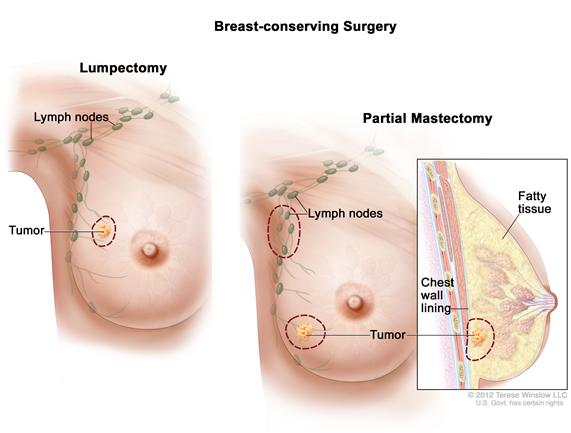 Breast-conserving surgery; drawing shows removal of the tumor and axillary lymph nodes.