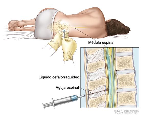 Punción lumbar; la imagen muestra a un paciente acostado sobre una camilla en posición encorvada y una aguja intrarraquídea o espinal, la cual es larga y fina, que se inserta en la parte inferior de la espalda. El recuadro muestra una vista de cerca de esta aguja insertada en el líquido cefalorraquídeo (LCR), en la parte inferior de la columna vertebral.