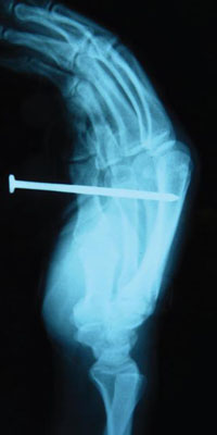 X-ray of nail gun injury