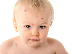 Bebé con varicela
