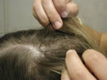 Examination of hair and scalp for head lice. Close examination of the hair and scalp is necessary to determine head lice infestation. (CDC Photo)