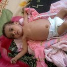 Photo: A one year old girl weighing 7 kg admitted to 
Al-Sabeen Hospital for malnutrition. Sana’a, Yemen, 2012. Photo submitted by Takia Jumaan – Yemen.