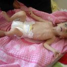 Photo: An 8 month old malnourished girl, weighing 3.45 kg, admitted to Al-Sabeen Hospital. Sana’a, Yemen, 2012.
Photo submitted by Takia Jumaan – Yemen.