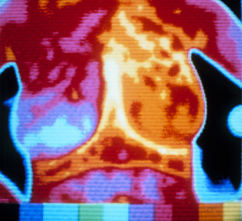 Thermogram No Substitute for Mammogram - Thermogram Image (JPG)