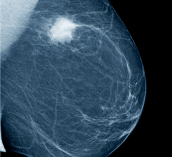 Thermogram No Substitute for Mammogram - Mammogram Image (JPG)