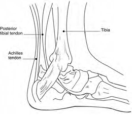 Illustration showing a lateral view of the ankle with the posterior tibial tendon and Achilles tendon called out.