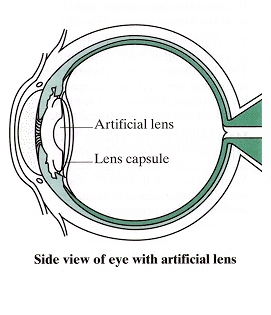 Side view of eye with artificial lens.