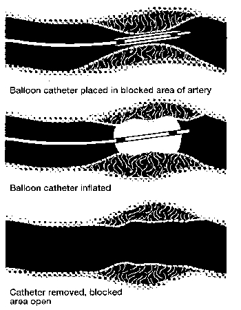 Cross-section of an artery showing how balloon angioplasty opens a blockage.